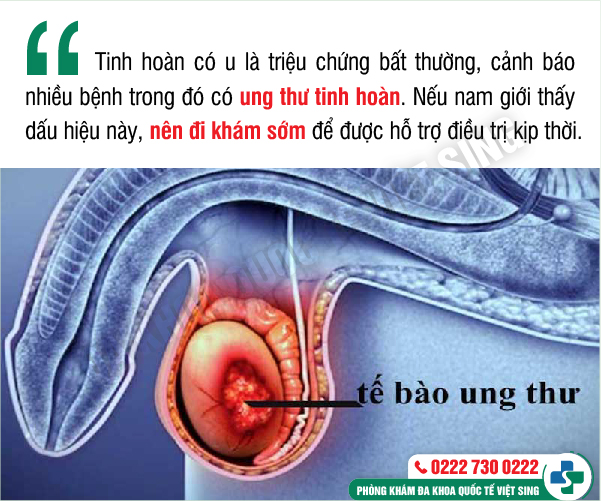 https://benhtrivietsing.com/wp-content/uploads/2023/06/1-tinh-hoan.jpg
