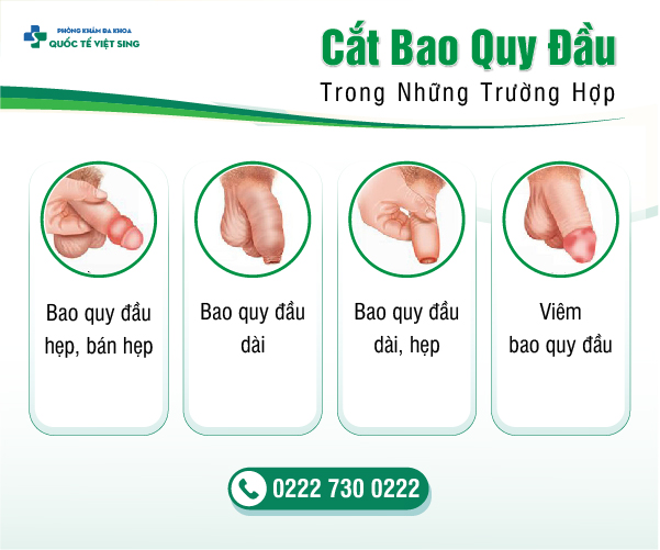 https://benhtrivietsing.com/wp-content/uploads/2023/06/doi-tương-cắt-bqd.jpg