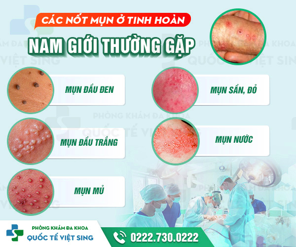https://benhtrivietsing.com/wp-content/uploads/2023/06/mun-tinh-hoan.jpg
