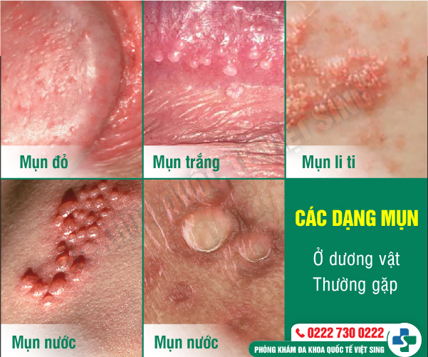 https://benhtrivietsing.com/wp-content/uploads/2023/07/mun-duong-vat.jpg