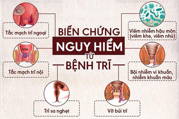 Chuyên gia hậu môn trực tràng bật mí: Cách chữa bệnh trĩ không tái phát